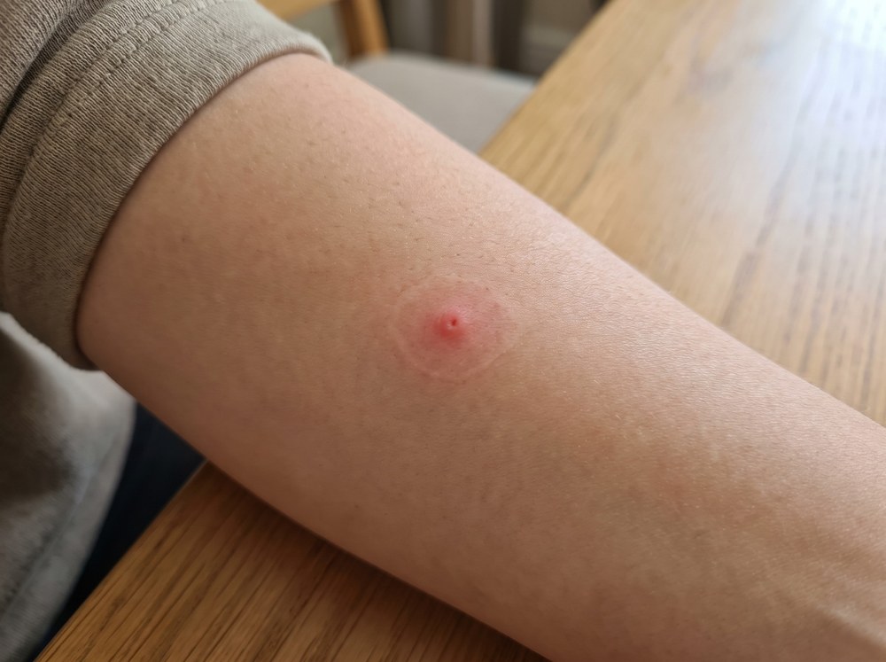 Close-up of a fresh house centipede bite showing two small red puncture marks with mild swelling on skin