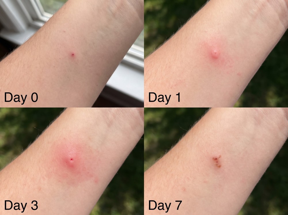 Side-by-side labeled comparison of a house centipede bite mark and a spider bite mark on human skin